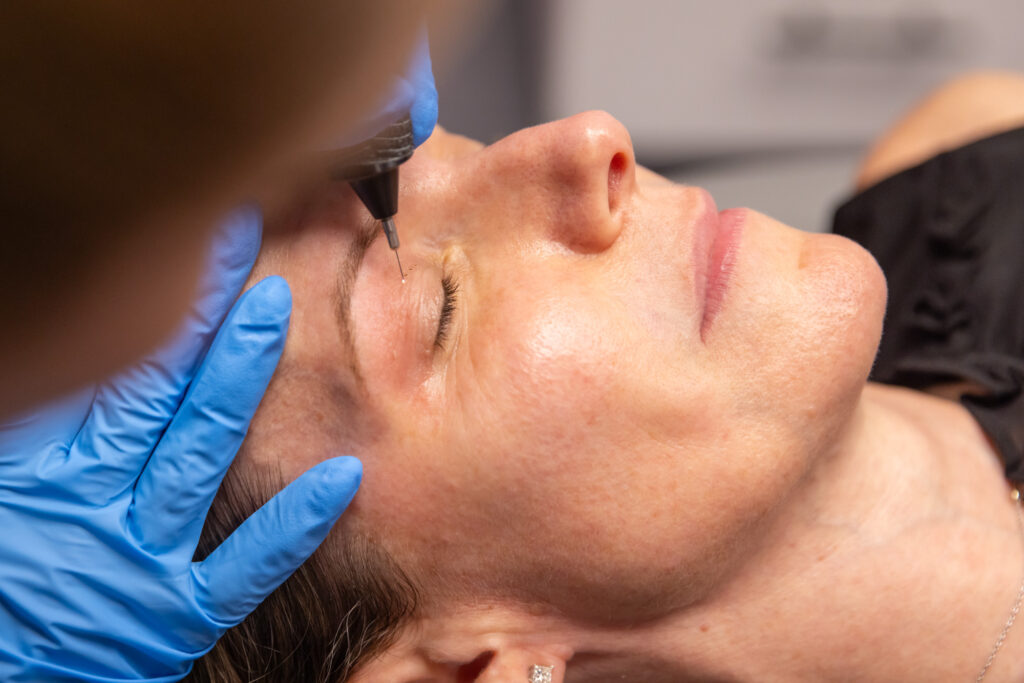 non-surgical blepharoplasty alternatives New Canaan CT physician medspa Dr Alasio