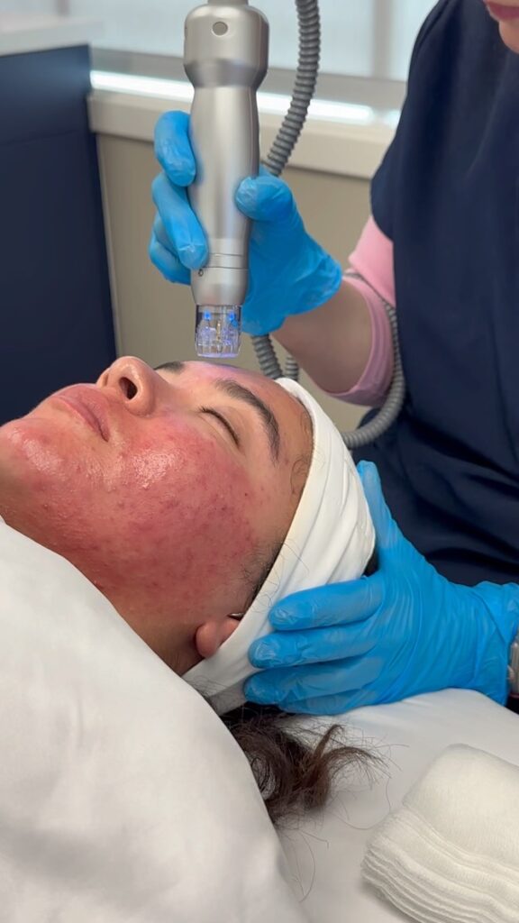 acne scar treatment with RF microneedling New Canaan CT physician-led medspa