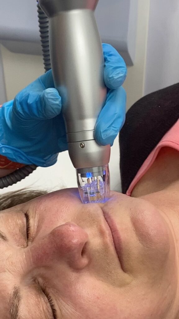 Scarlet RF microneedling sessions New Canaan CT physician medspa Dr Alasio