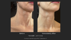 Neck rejuvenation New Canaan 