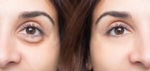 Eye rejuvenation surgery New Canaan