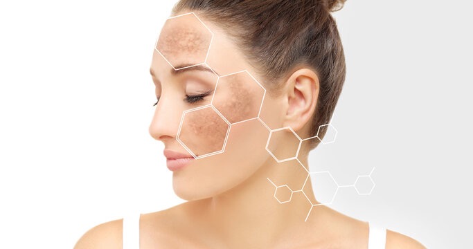 melasma vs chloasma difference physician New Canaan CT Dr Teresa Alasio