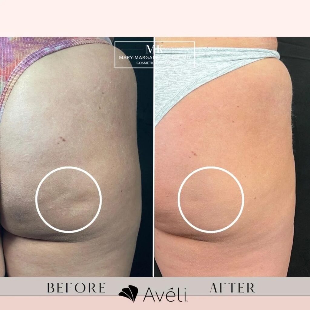cellulite treatment Aveli Attiva New Canaan CT physician medspa Dr Alasio