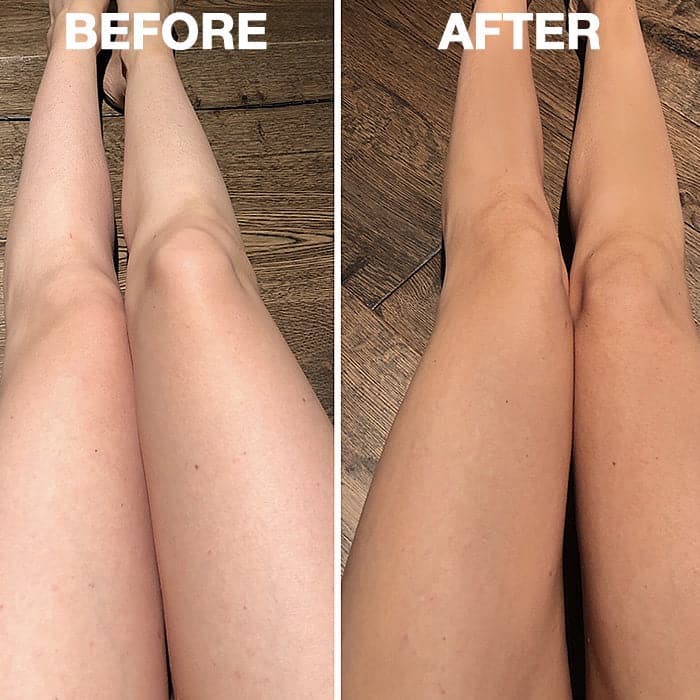 self tanner laser treatment safety New Canaan CT physician medspa Dr Alasio