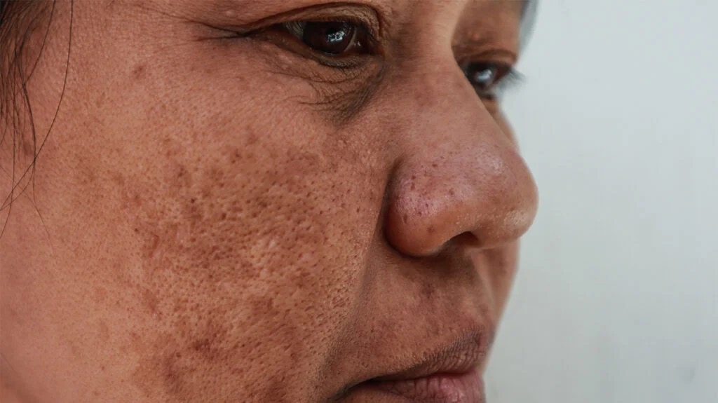 what is melasma physician explanation New Canaan CT Dr Teresa Alasio