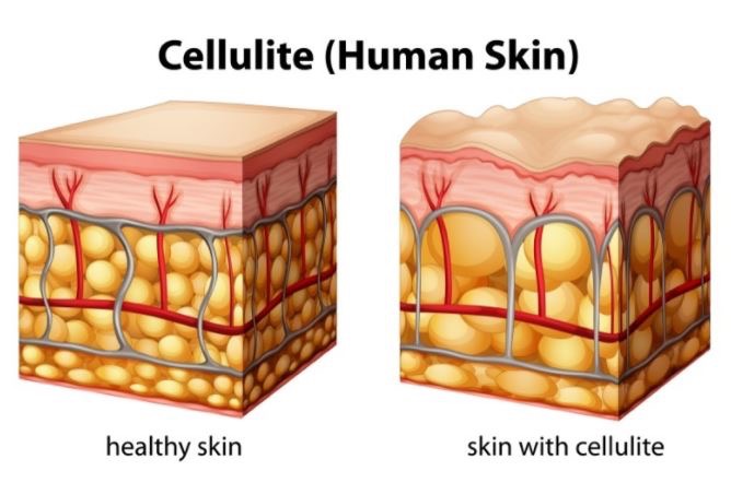 cellulite treatment in New Canaan CT at Intentional Self Aesthetics